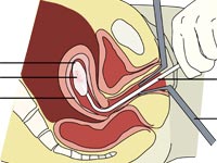 A diagram of a vacuum aspiration abortion procedure at 8 weeks gestation, from Wikipedia