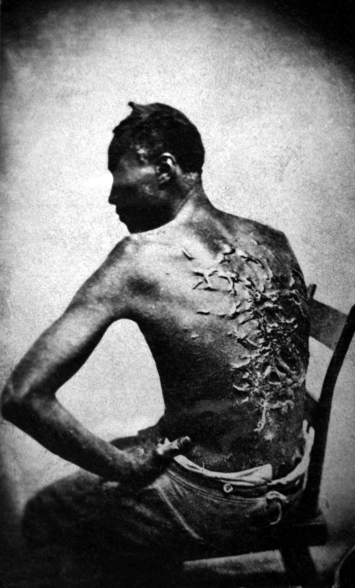 Whipped back of a slave, photo taken in Louisiana, 1863